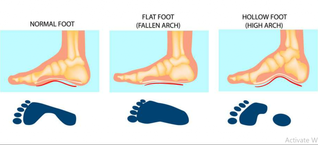 Difference Between A High Arch And A Fallen Arch